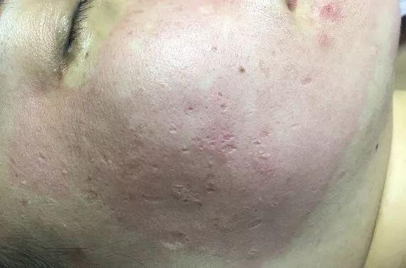 簡單有效的痘坑修復(fù)方法,讓你的肌膚重拾光彩,簡單有效的痘坑修復(fù)秘訣,重塑肌膚光彩!