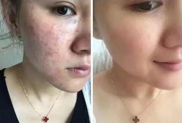 如何有效去除臉上的痘痘和痘印——全方位指南,全方位指南,如何有效去除臉部痘痘與痘印的方法