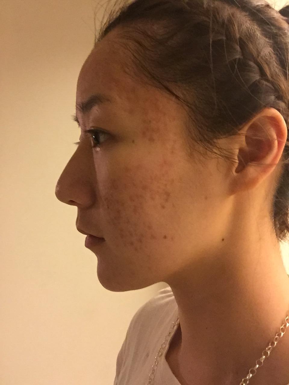 如何有效去除臉上的痘印——全方位指南,全方位指南,如何有效去除臉上痘印的方法