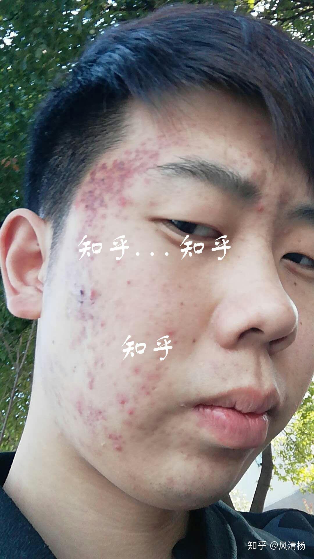 如何有效去除臉上的痘印——全方位指南,全方位指南,如何有效去除臉上痘印的方法