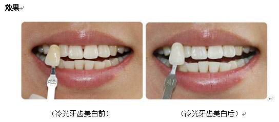 牙齒冷光美白需要多少錢?全面解析費用因素及注意事項,牙齒冷光美白費用全解析,價格、因素與注意事項