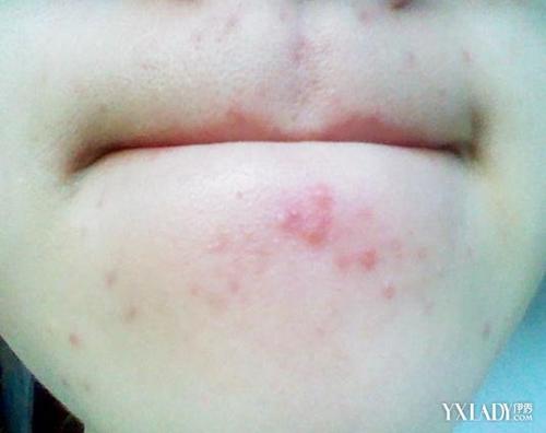 下巴周圍反復長痘痘的原因及解決方法，下巴周圍反復長痘成因與解決策略