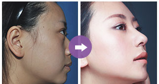 關于只做鼻翼縮小手術的費用分析，只做鼻翼縮小手術的費用詳解