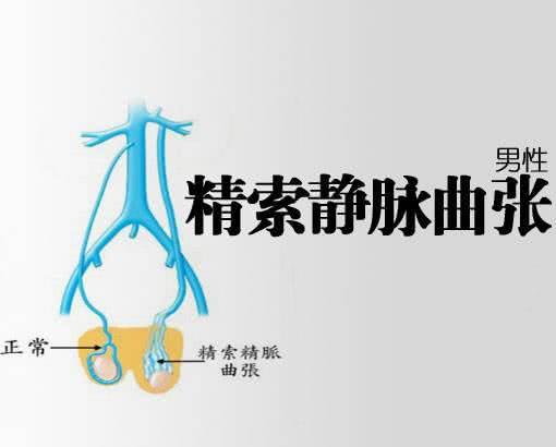 精索靜脈曲張的癥狀表現(xiàn)及其影響，精索靜脈曲張的癥狀表現(xiàn)及其潛在影響
