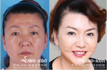 美容去皺紋針的價格，了解一針的價格及更多細(xì)節(jié)，美容去皺針價格解析，一針的價格及更多細(xì)節(jié)揭秘