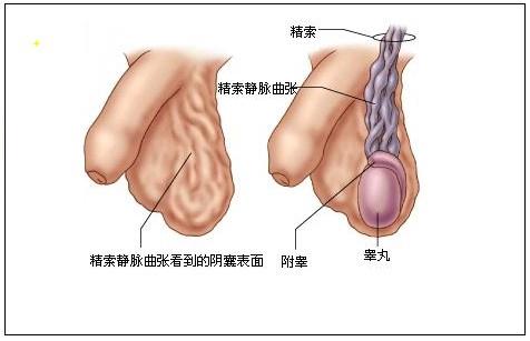 精索靜脈曲張，了解、預防與治療，精索靜脈曲張，全面解析了解、預防與治療策略