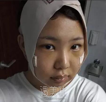 磨骨一年后的驚人變化，對比照片揭示細節，磨骨一年后的驚人變化，細節對比揭示驚人效果