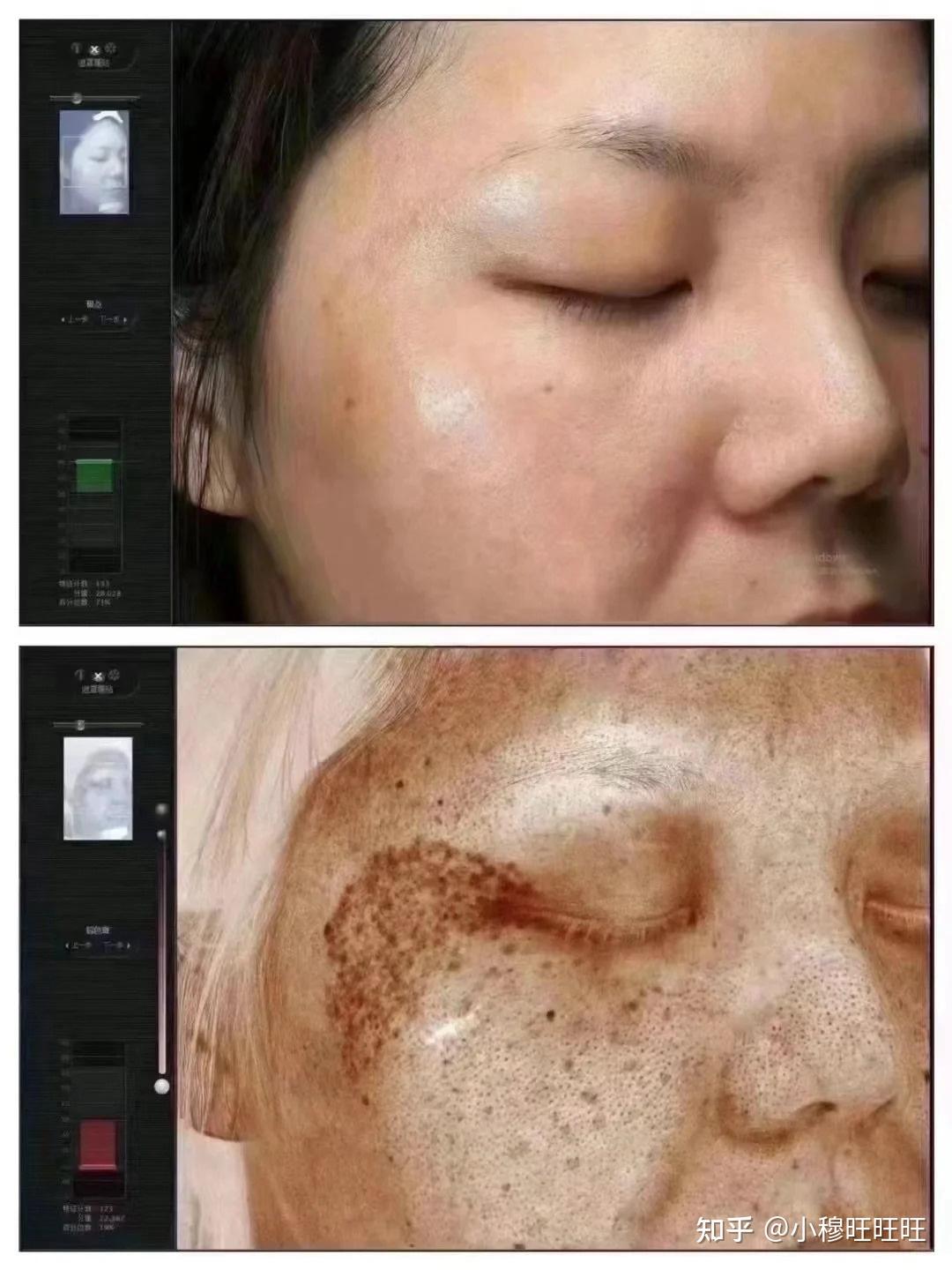 激光祛斑，選擇醫(yī)院還是美容院？全面解讀助您做出明智決策，激光祛斑，如何選擇醫(yī)院與美容院？全面解讀為您指明決策方向