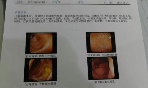 如何判斷痔瘡還是息肉，癥狀、診斷與治療方法，痔瘡與息肉，癥狀、診斷及治療方法詳解
