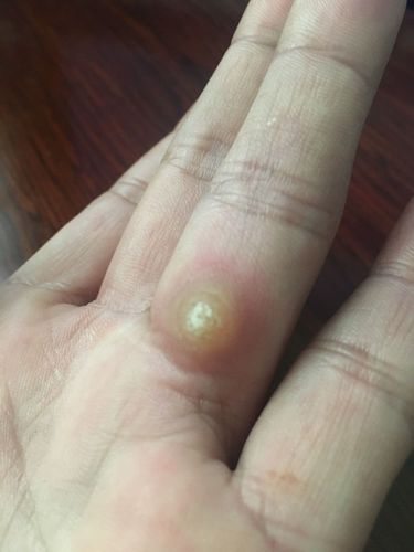手上長雞眼初期圖片，了解、預防與治療，手上長雞眼，初期圖片、預防與治療方法全解析