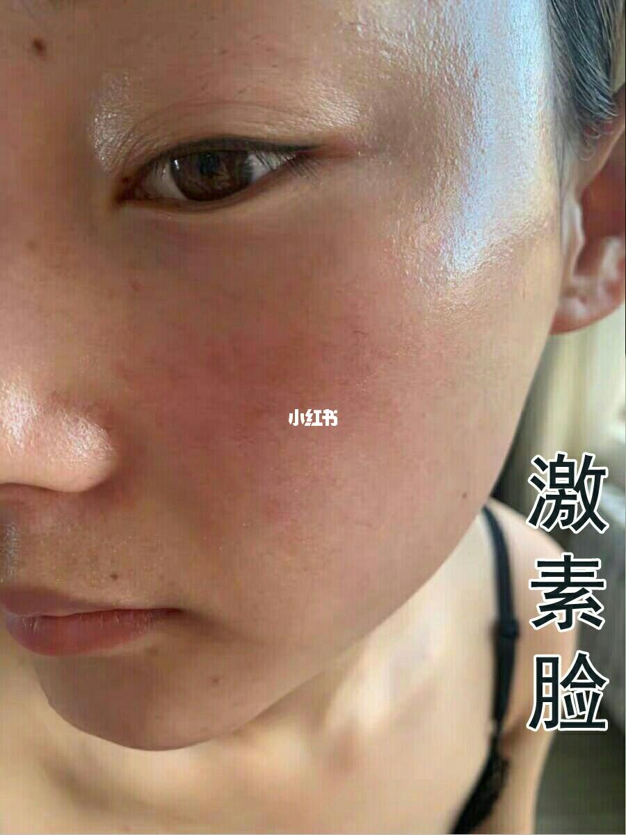 面部激素臉圖片及其相關問題解析，面部激素臉圖片解析及相關問題探討