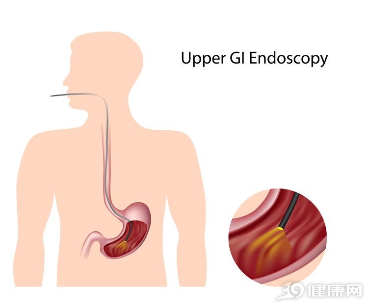 做胃鏡難受嗎？全面解析胃鏡檢查的體驗與注意事項，胃鏡檢查全面解析，體驗、難受程度及注意事項探討