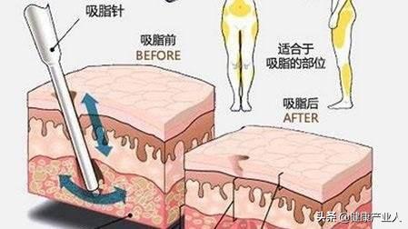 藥物減肥哪種效果好,全面解讀與比較各種藥物減肥方法,全面解讀與比較,哪種藥物減肥方法效果最好?