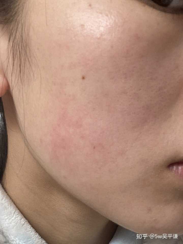 敏感肌膚修復(fù)指南,如何恢復(fù)健康正常肌膚,敏感肌膚修復(fù)全攻略,重塑健康肌膚的秘訣