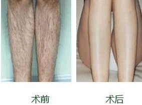 激光脫毛,價格因素詳解,激光脫毛詳解,價格因素剖析