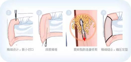抽脂減肥反彈現象,原因與應對策略,抽脂減肥反彈原因及應對策略解析