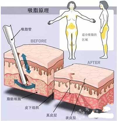 抽脂減肥反彈現象,原因與應對策略,抽脂減肥反彈原因及應對策略解析