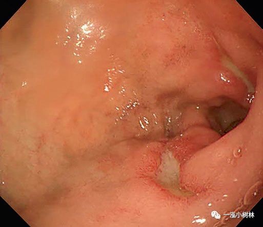 十二指腸潰瘍,成因、癥狀及防治策略,十二指腸潰瘍,成因、癥狀與防治方法全解析