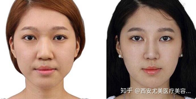 縮鼻頭手術費用詳解,大概需要多少錢?,鼻頭縮小手術費用全解析,了解縮鼻頭手術大概需要多少錢?