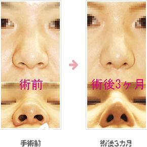 縮鼻頭手術費用詳解,大概需要多少錢?,鼻頭縮小手術費用全解析,了解縮鼻頭手術大概需要多少錢?