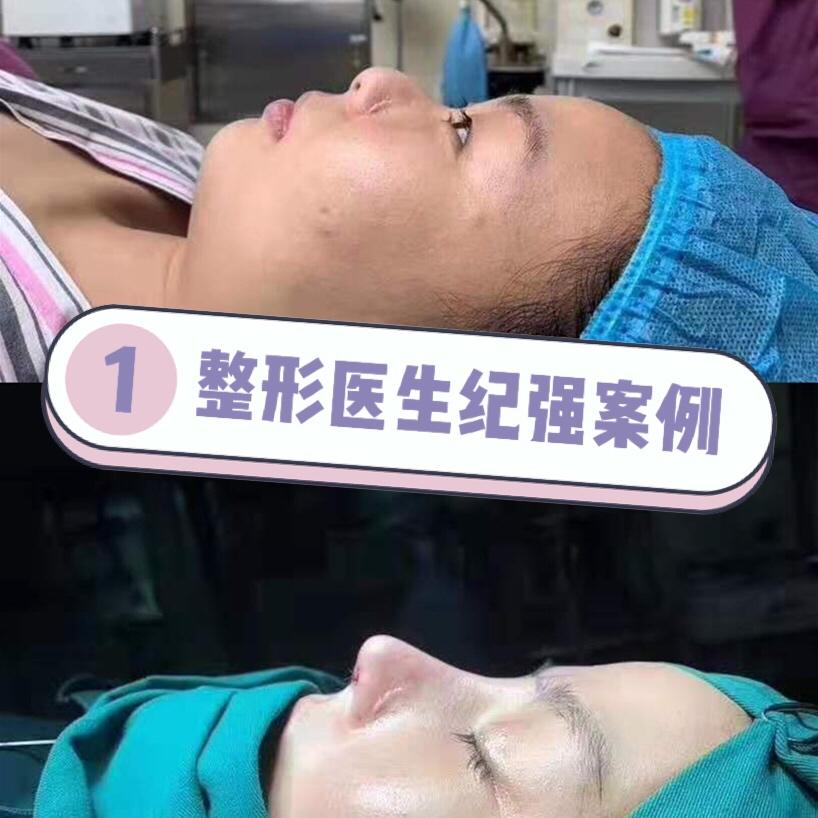 縮鼻頭手術費用詳解,大概需要多少錢?,鼻頭縮小手術費用全解析,了解縮鼻頭手術大概需要多少錢?