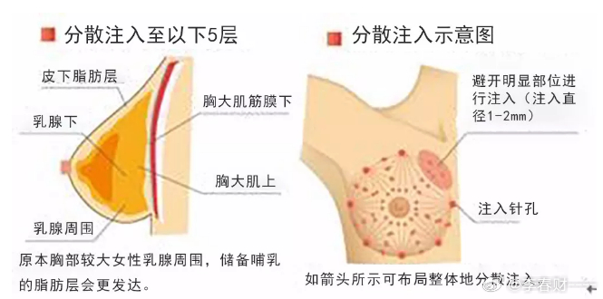 豐胸手術對身體的影響,全面解析風險與后果,豐胸手術風險與后果全面解析,對身體的影響探討