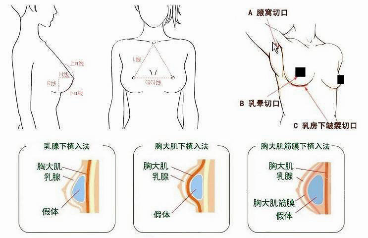 豐胸手術對身體的影響,全面解析風險與后果,豐胸手術風險與后果全面解析,對身體的影響探討