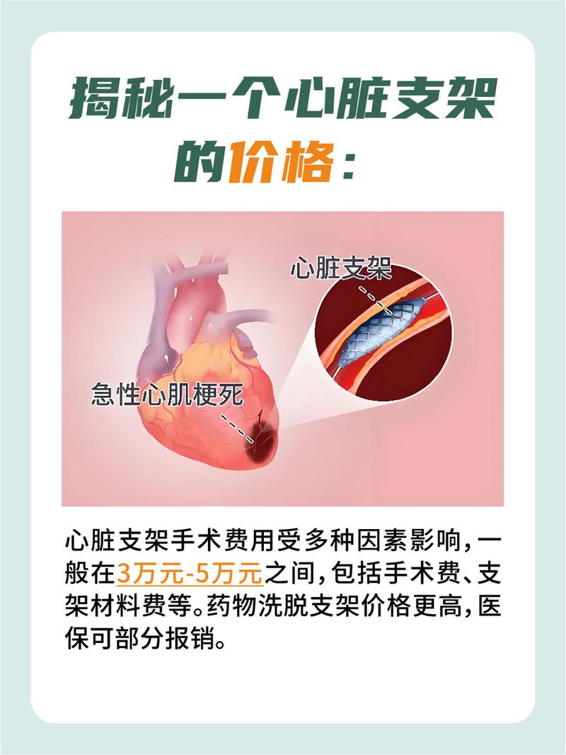 關(guān)于血管支架的價(jià)格,你需要知道的一切,血管支架價(jià)格全解析,你需要了解的一切