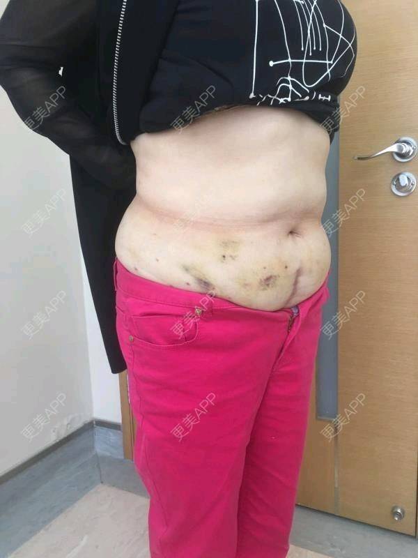 腰腹吸脂后1到7天恢復過程圖片展示,腰腹吸脂術后恢復過程圖片展示(1-7天)