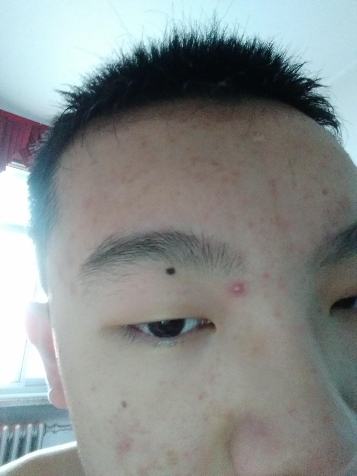 臉上痘痘太多了怎么辦？全方位護膚指南助你擺脫困擾，全方位護膚指南，解決臉部痘痘困擾，重拾肌膚光彩