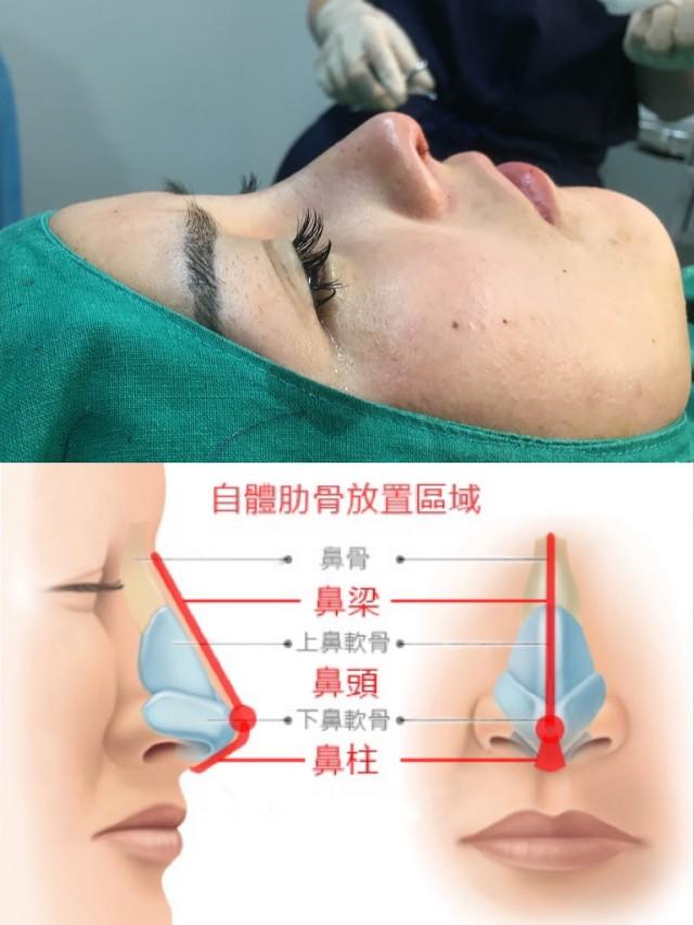鼻綜合整形項目詳解，包括哪些項目？，鼻綜合整形項目詳解，涵蓋內容與整形項目概覽