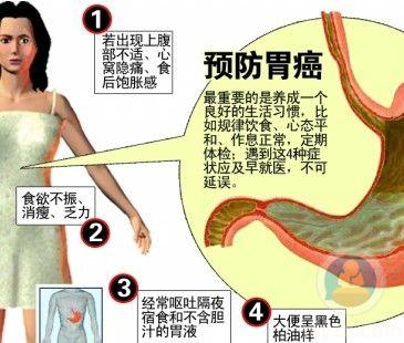 女胃癌的早期癥狀,了解并預(yù)防的關(guān)鍵信息,女性胃癌早期癥狀解析,預(yù)防與關(guān)鍵信息指南