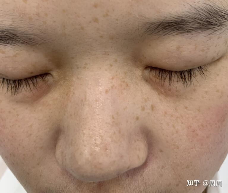 如何淡化雀斑最有效,綜合方法與日常護理,如何有效淡化雀斑,綜合方法與日常護理全解析
