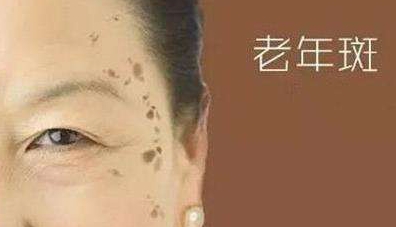 如何預防不長老年斑——秘訣大揭秘,揭秘預防老年斑的秘訣,讓你遠離斑點困擾!