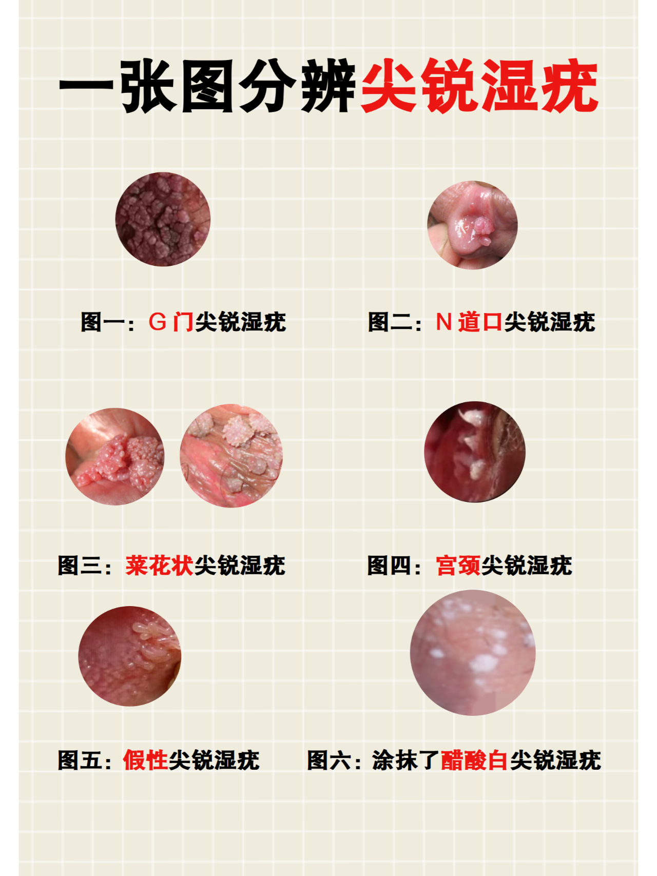 尖銳濕疣圖片,了解、識別與防治,尖銳濕疣圖片詳解,識別、防治全攻略