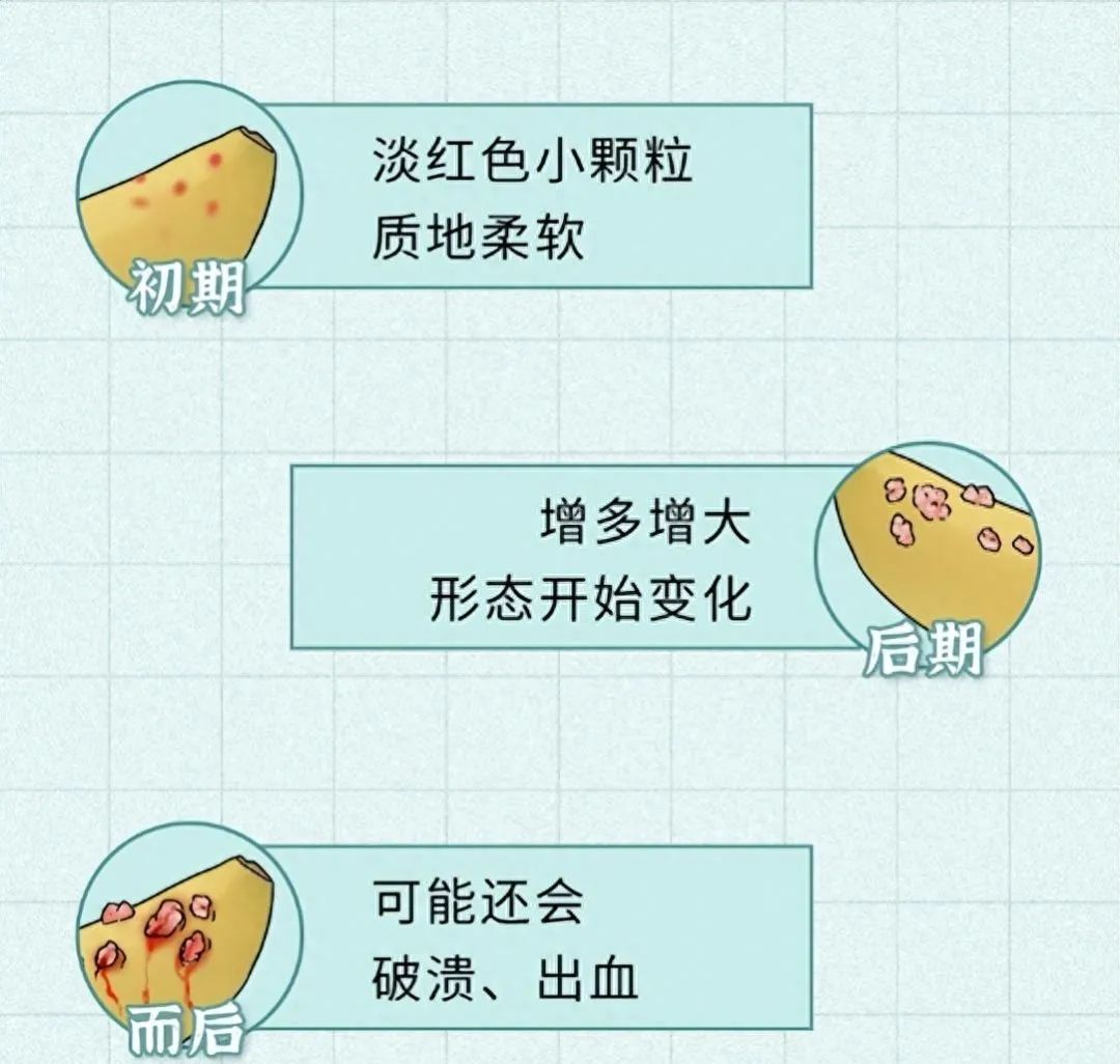 尖銳濕疣圖片,了解、識別與防治,尖銳濕疣圖片詳解,識別、防治全攻略