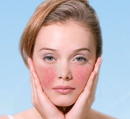 改善面部紅血絲的方法,改善面部紅血絲的有效方法