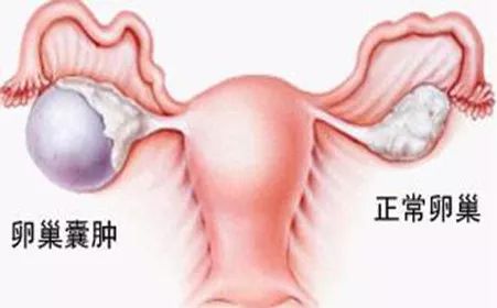 卵巢囊腫的十個征兆,卵巢囊腫的十個征兆解析