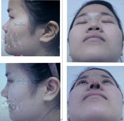 鼻頭縮小整形價格詳解,因素、費用及注意事項,鼻頭縮小整形價格解析,費用、因素與注意事項全指南