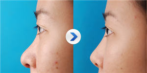 鼻頭縮小整形價格詳解,因素、費用及注意事項,鼻頭縮小整形價格解析,費用、因素與注意事項全指南