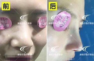 鼻頭縮小整形價格詳解,因素、費用及注意事項,鼻頭縮小整形價格解析,費用、因素與注意事項全指南