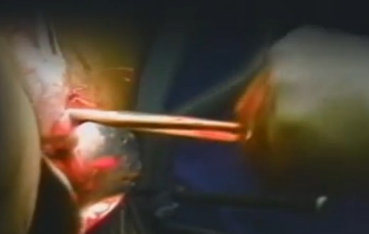 實拍醫院人流手術全過程,深入了解手術過程與細節,醫院人流手術全過程實錄,探究手術過程與細節