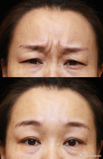 川字紋消除小偏方——讓你輕松告別皺紋困擾,川字紋消除偏方,告別皺紋,輕松展現年輕光彩!