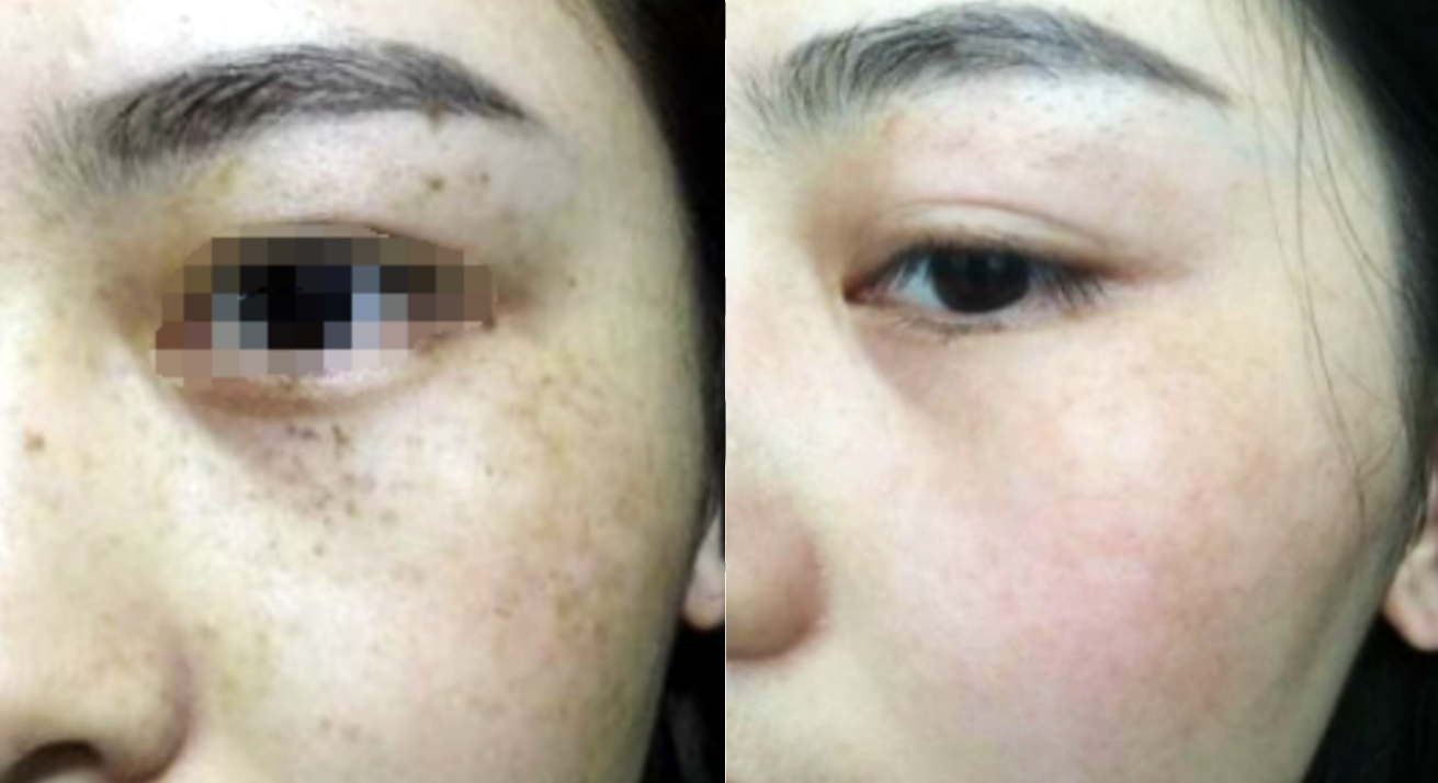 臉上長斑是怎么回事,成因與解決方案,臉上長斑成因解析及解決方案