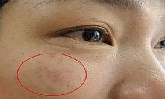 臉上長斑是怎么回事,成因與解決方案,臉上長斑成因解析及解決方案