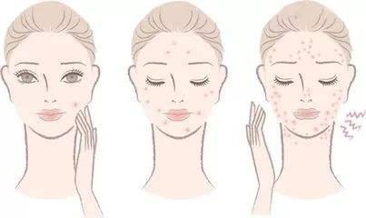 有什么辦法可以去除痘印?全面解析痘印消除方法,全面解析,痘印消除方法與技巧