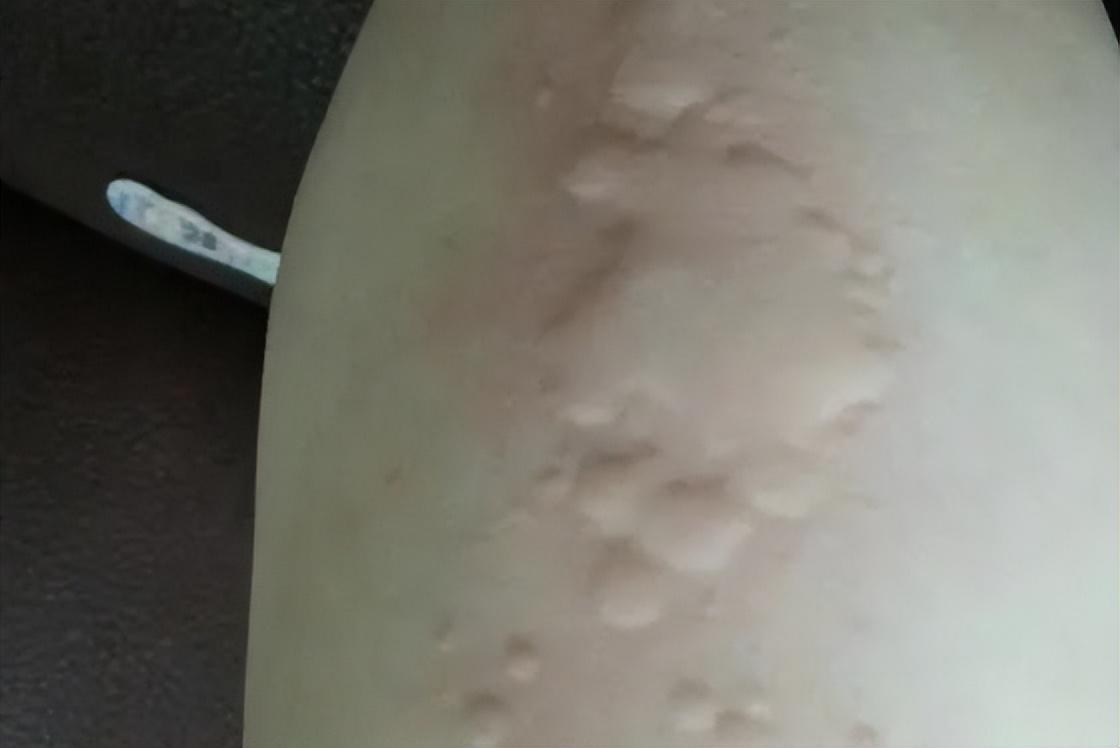 大蒜,治癬的最好的偏方,大蒜,治癬最佳偏方揭秘