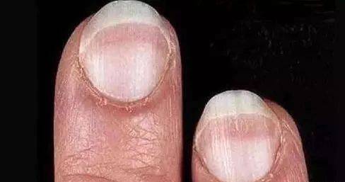 肝不好指甲圖片,揭示指甲變化與肝臟健康的關系,指甲變化揭示肝臟健康,圖片解析指甲與肝臟的聯系