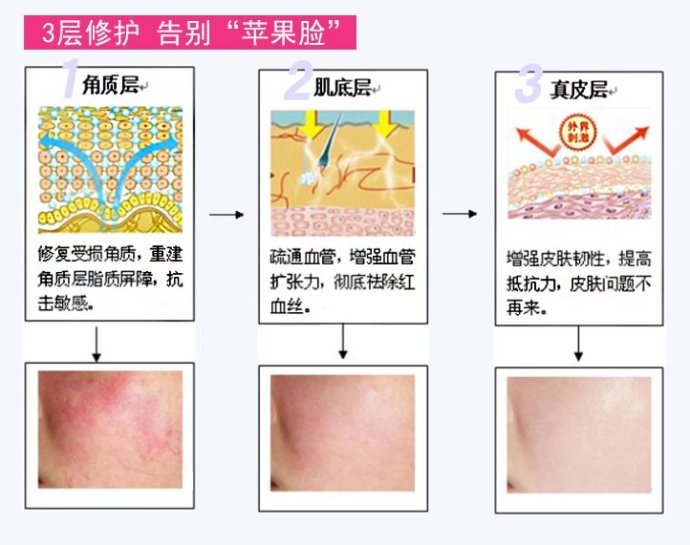 治療紅血絲的最佳方法,治療紅血絲的最佳方法簡述