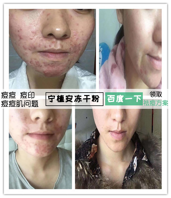 臉上突然長了好多紅色的痘痘,原因、治療與預防,臉部紅色痘痘,成因、治療與預防措施